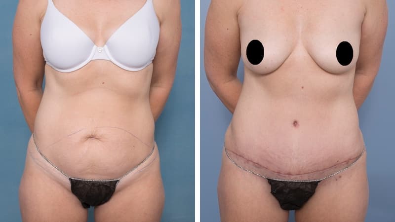 Abdominoplasty Liposuction Waist