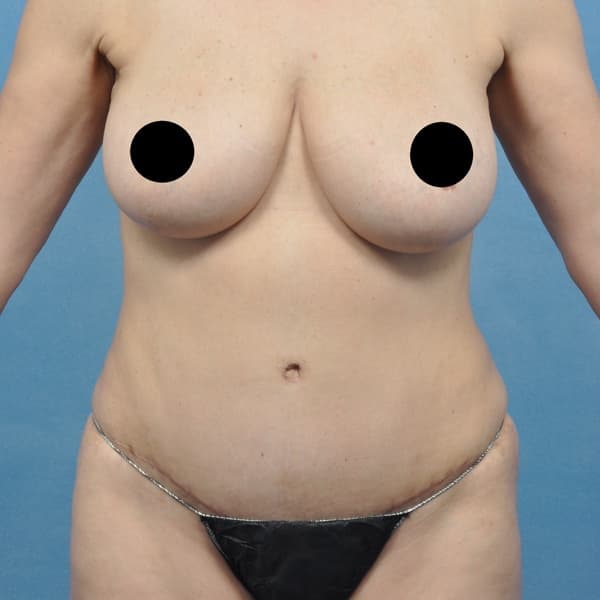 Abdominoplasty & Liposuction - Post Op