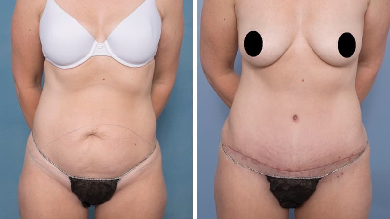 Abdominoplasty Liposuction Flanks and Lateral Thighs