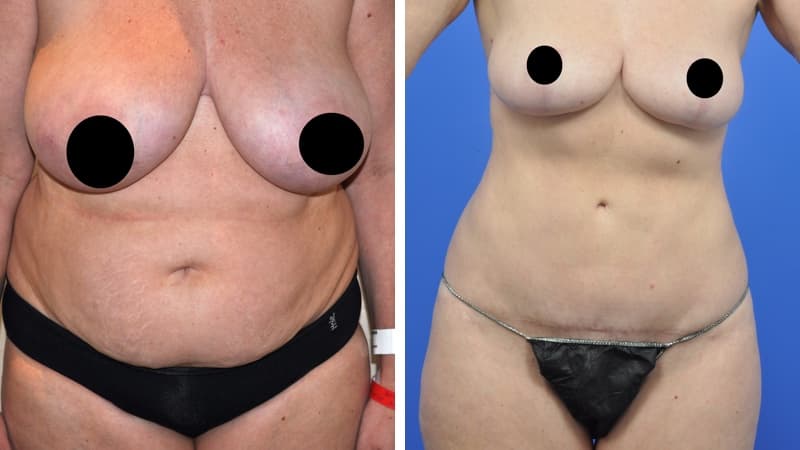 Breast Reduction & Body Lift