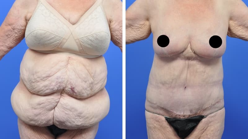 Body Lift & Breast Reduction
