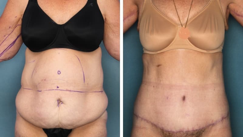 Body Lift Liposuction Waist Staged Procedures