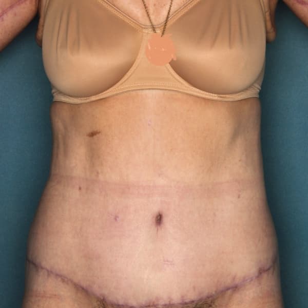 Body Lift Liposuction Waist Staged Procedures - Post Op