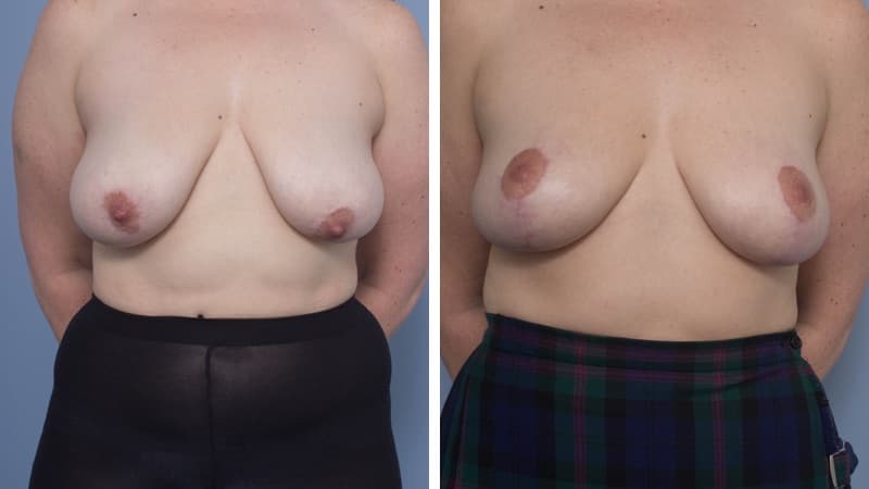 Breast Reduction – Breast Asymmetry Correction