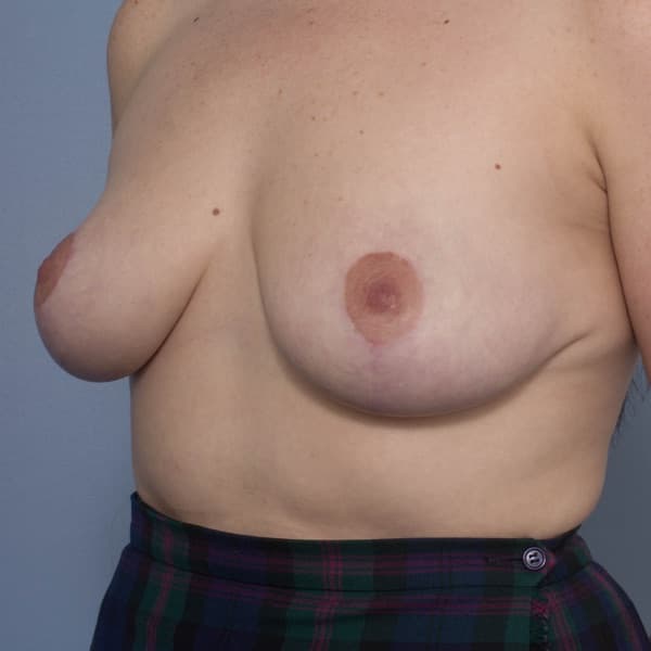 Breast Reduction - Breast Asymmetry Correction - Post Op