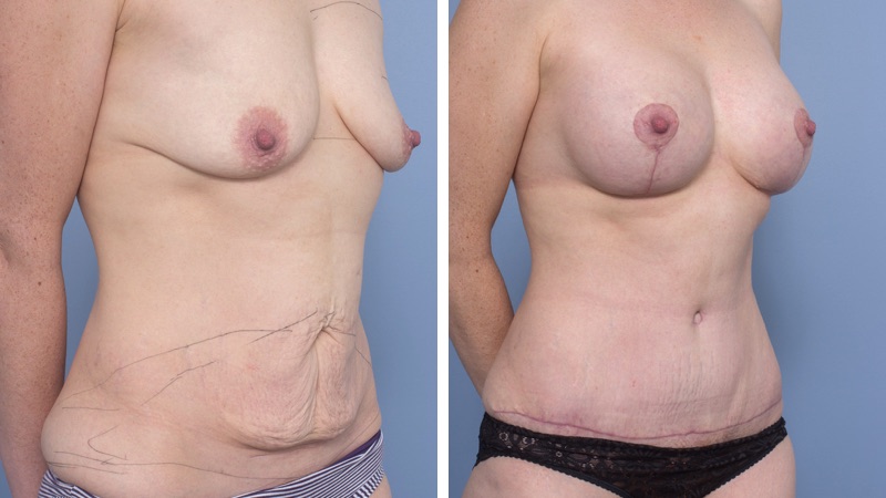 Mummy Makeover / Breast Lift with Implants