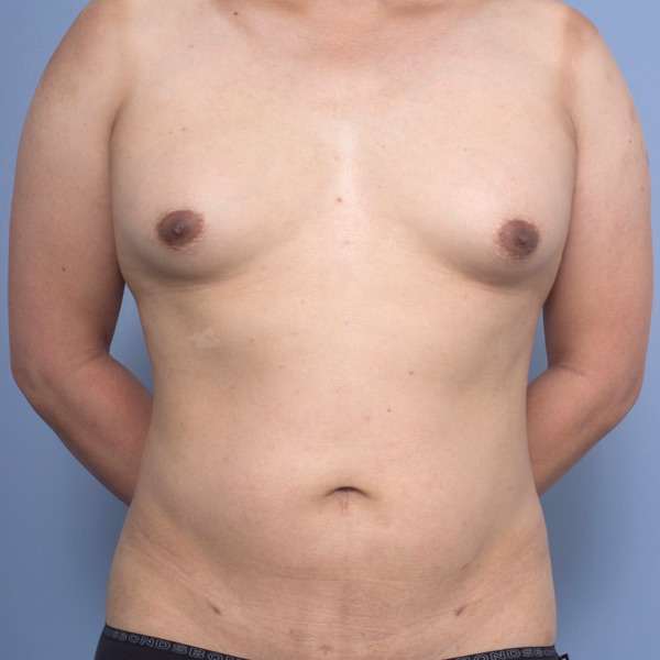 Liposuction & Fat Grafting - Post Op