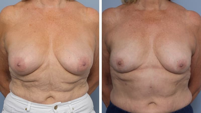 Liposuction only Breast Reduction