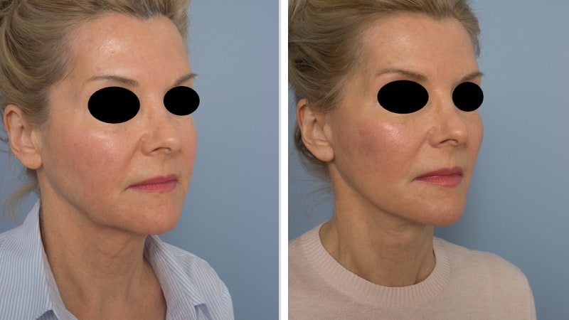 Lower Face and Necklift – Before & After